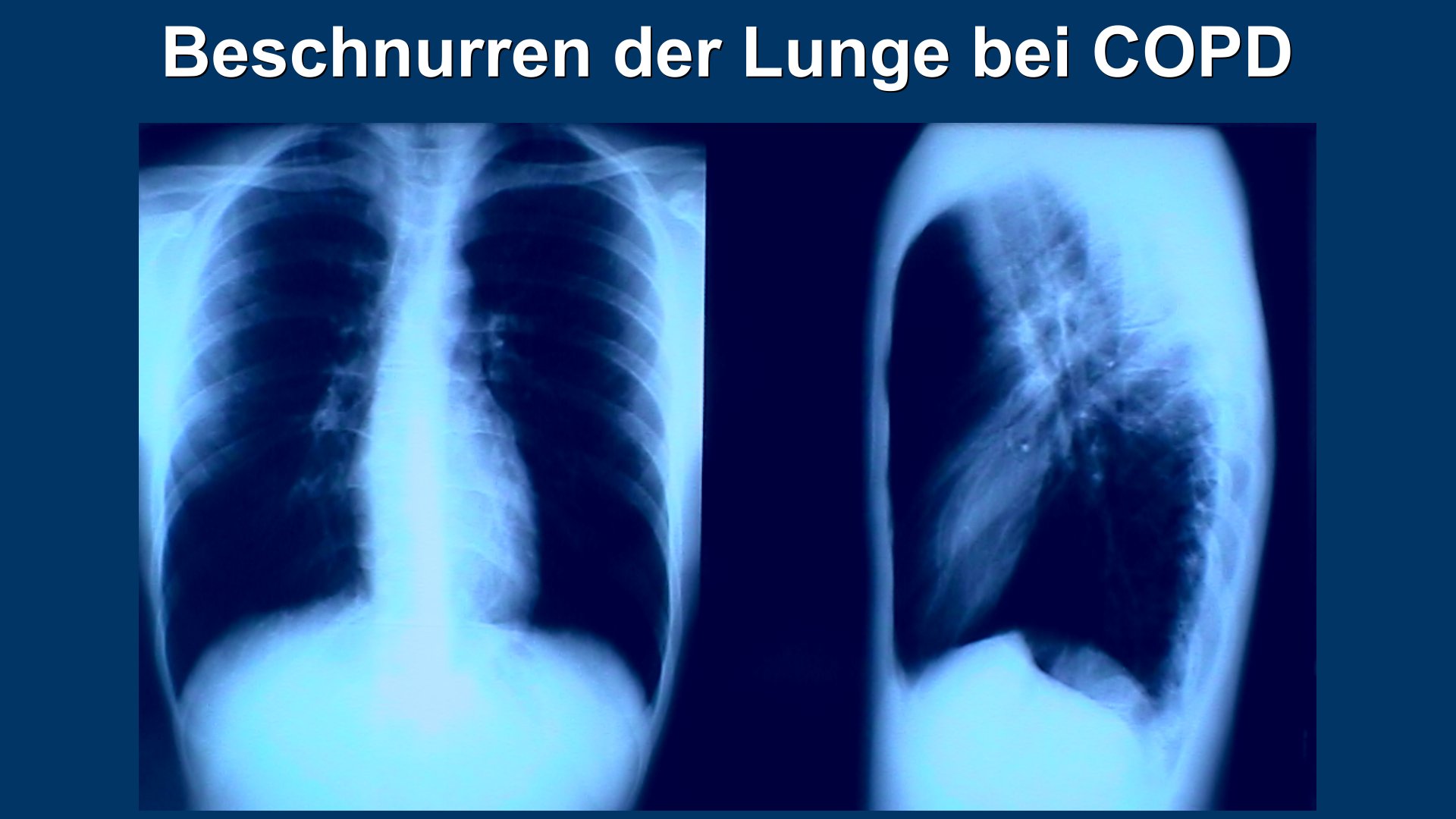 Lunge Röntgen COPD